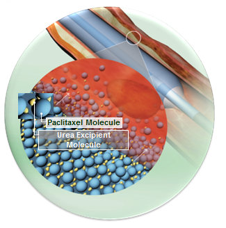 Peripheral Drug Coated Balloons: A New Era