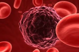 Adenosine deaminase (ADAR1) promotes malignant stem cell cloning and thus blood cancer 