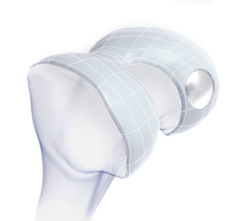 Episurf Medical's Episealer Femoral Condyle treats cartilage damage in the knee, restoring movement and reducing pain