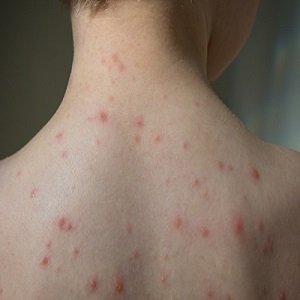 41 cases of measles have been reported in Queensland so far