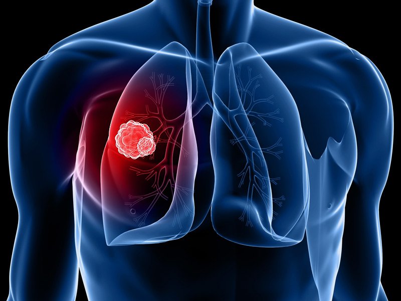 Researchers find out specific Blood Test to treat Lung Cancer